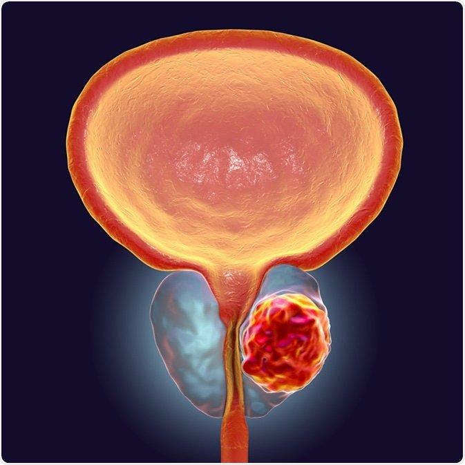 MRI to Diagnose Prostate Cancer