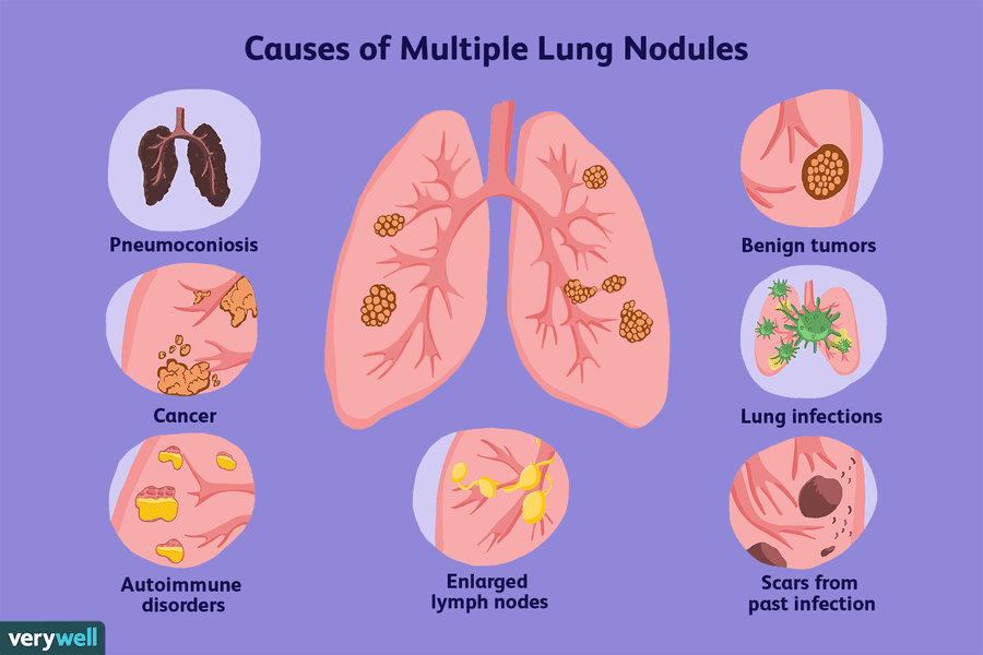 Multiple Lung Nodules: Overview and More