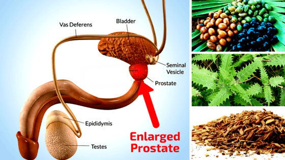 Natural Remedies For Enlarged Prostate Gland