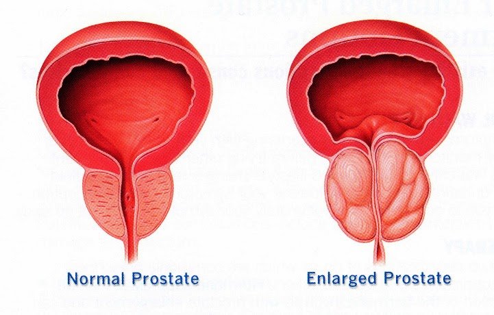Nursing Priorities and Diagnosis for Benign Prostatic ...