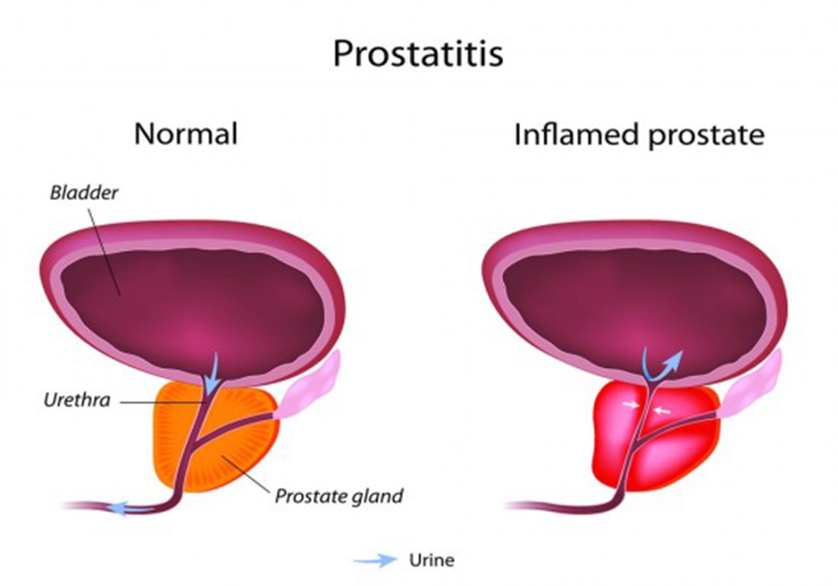 Possible causes of prostatitis
