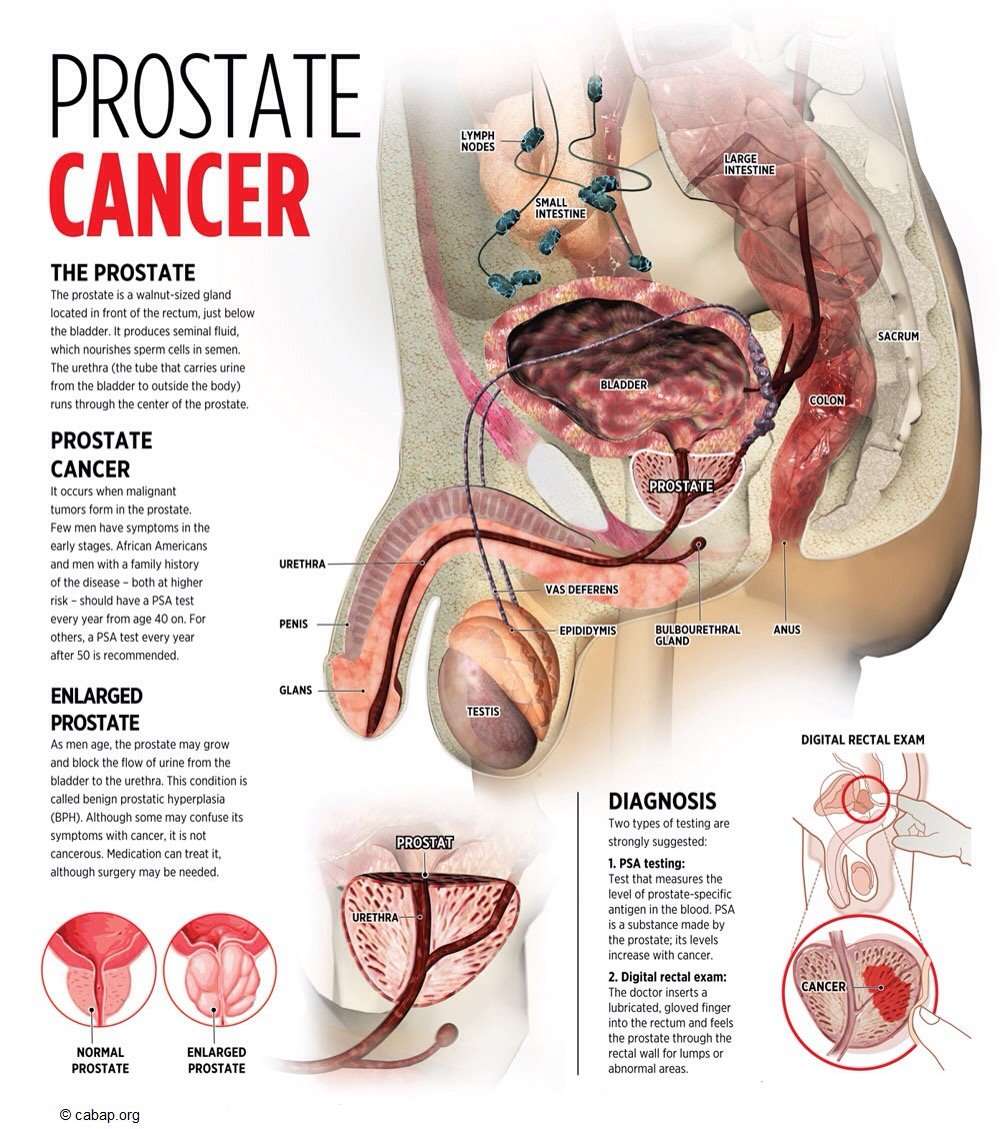 PrÃ©vention du cancer de la prostate.