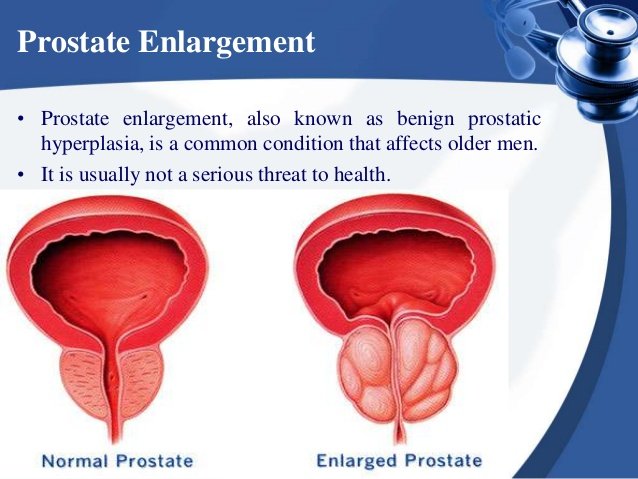 Prevention Diet: Foods For An Enlarged Prostate