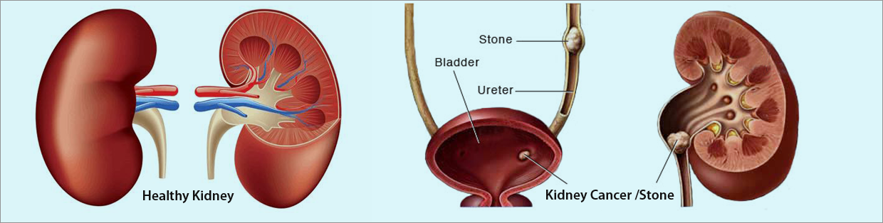 Prostate Cancer Bladder Cancer Urologist Uro Surgeon