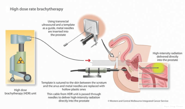 Prostate Cancer Brachytherapy