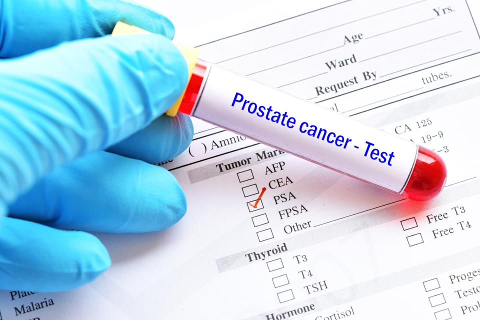 Prostate cancer diagnosed via AI