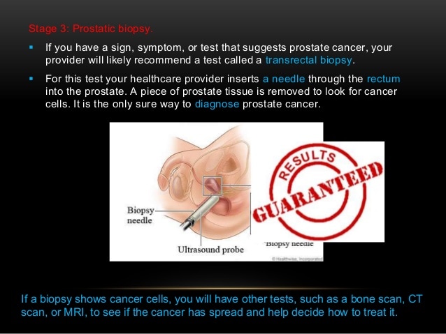 Prostate cancer for public awareness by DR RUBZ