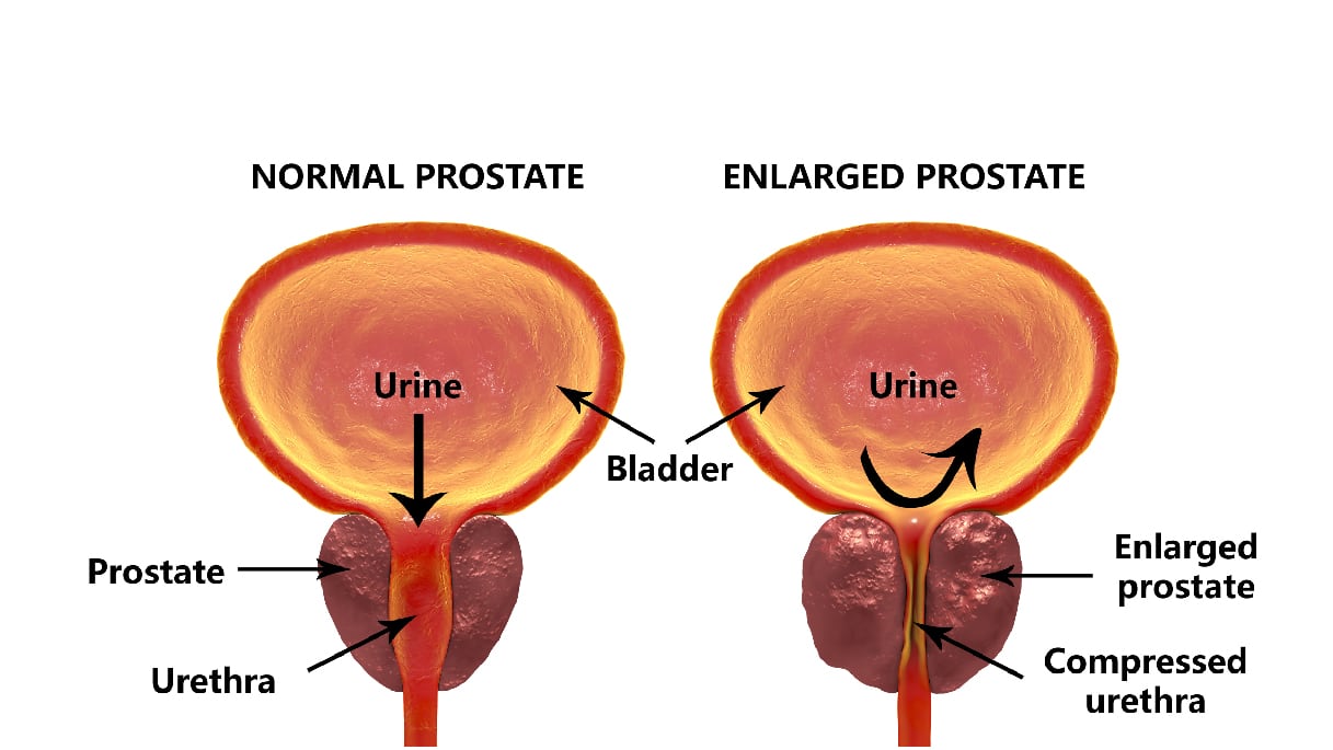 Prostate Cancer in Men