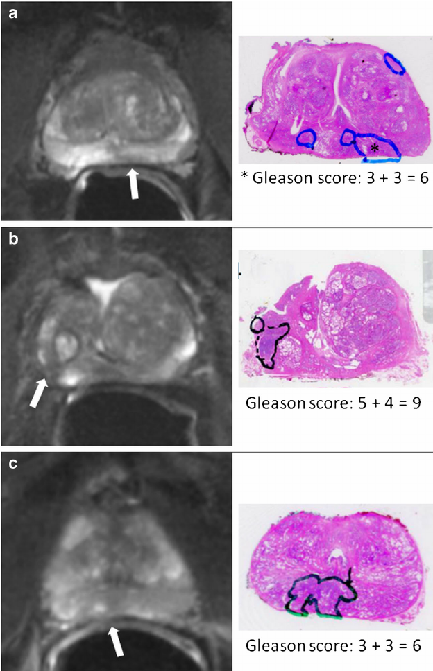 Prostate cancer lesions on axial T2