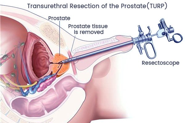 Prostate cancer surgery in Ludhiana, Punjab