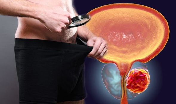 Prostate cancer symptoms: Noticing this in your semen ...