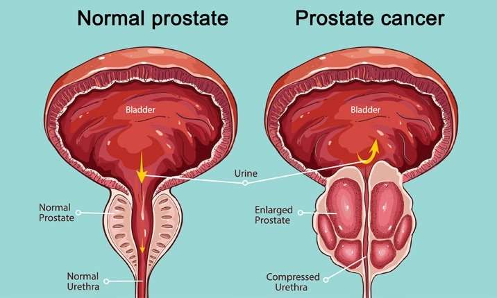 Prostate Cancer treatments