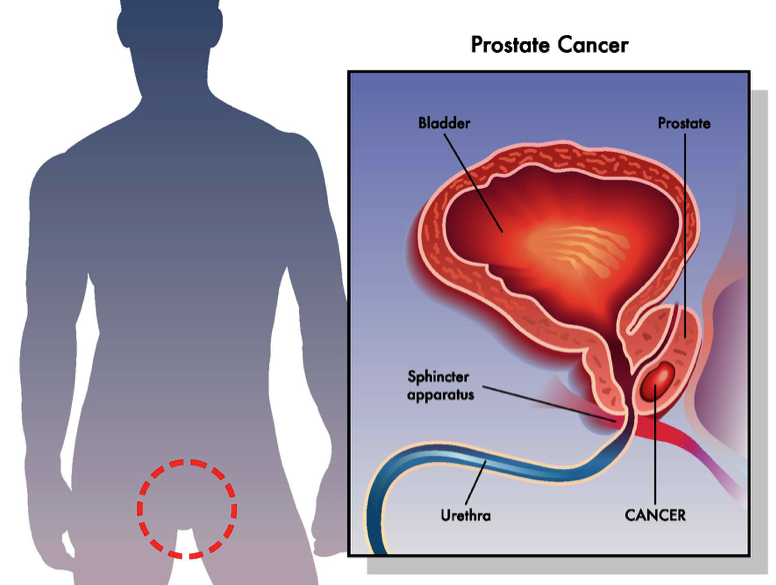 Prostate Cancer: What You Need to Know