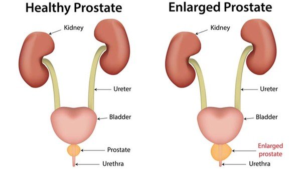 prostate gland enlargement treatment ayurvedic