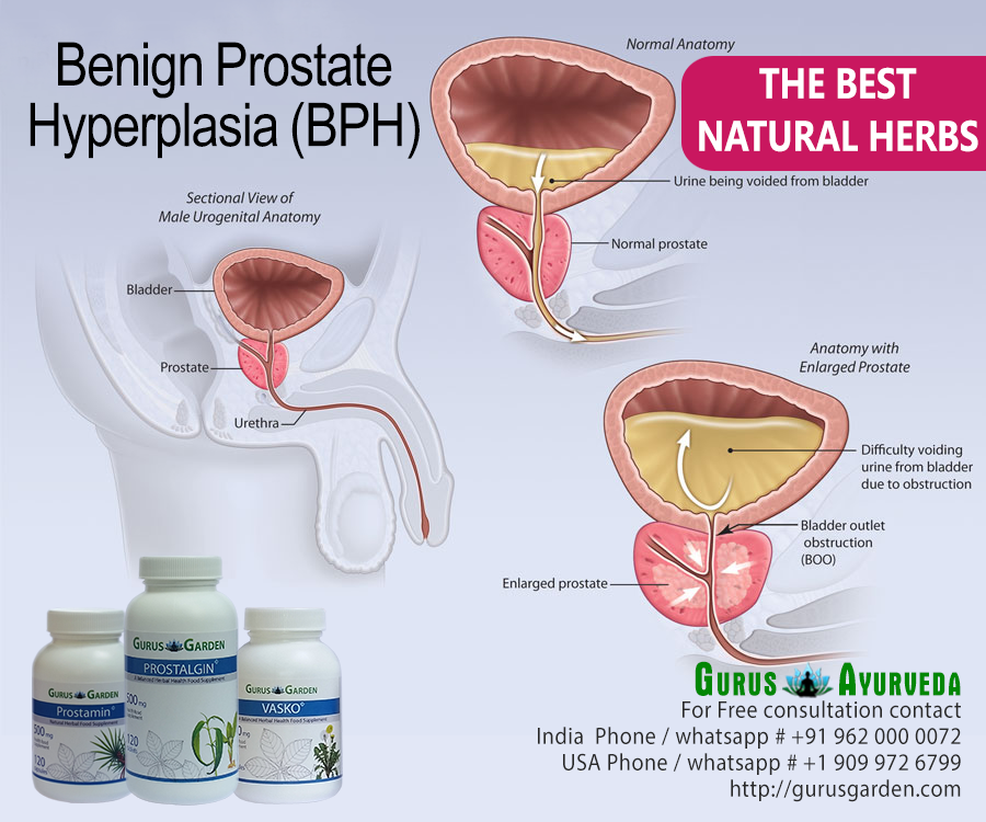 prostate health remedies, Signs and Symptoms and how to ...