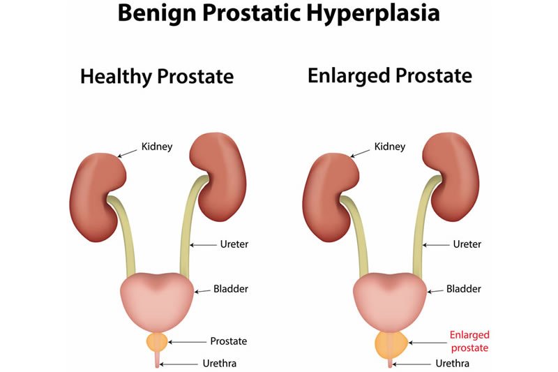 Prostate Issues and Erectile Dysfunction