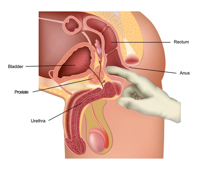 Prostate Milking Procedure
