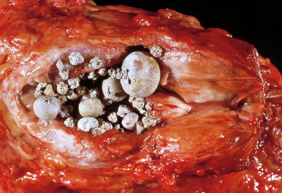 Prostate Stones Photograph by Cnri/science Photo Library