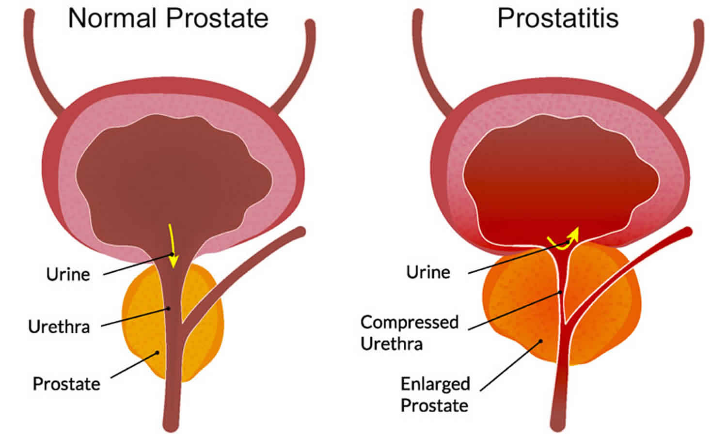 Prostatitis acute or chronic causes, symptoms, diagnosis ...