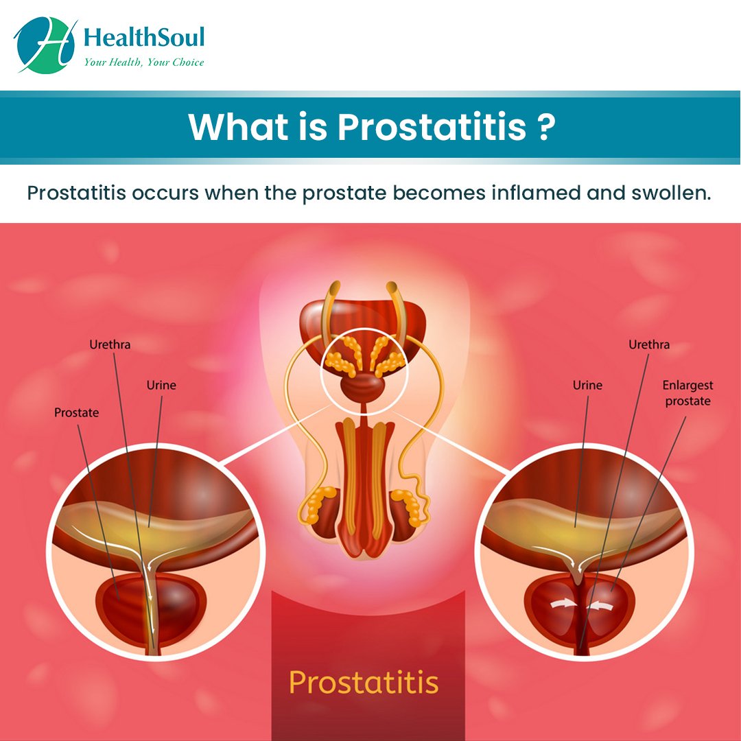 Prostatitis: Symptoms, Diagnosis and Treatment
