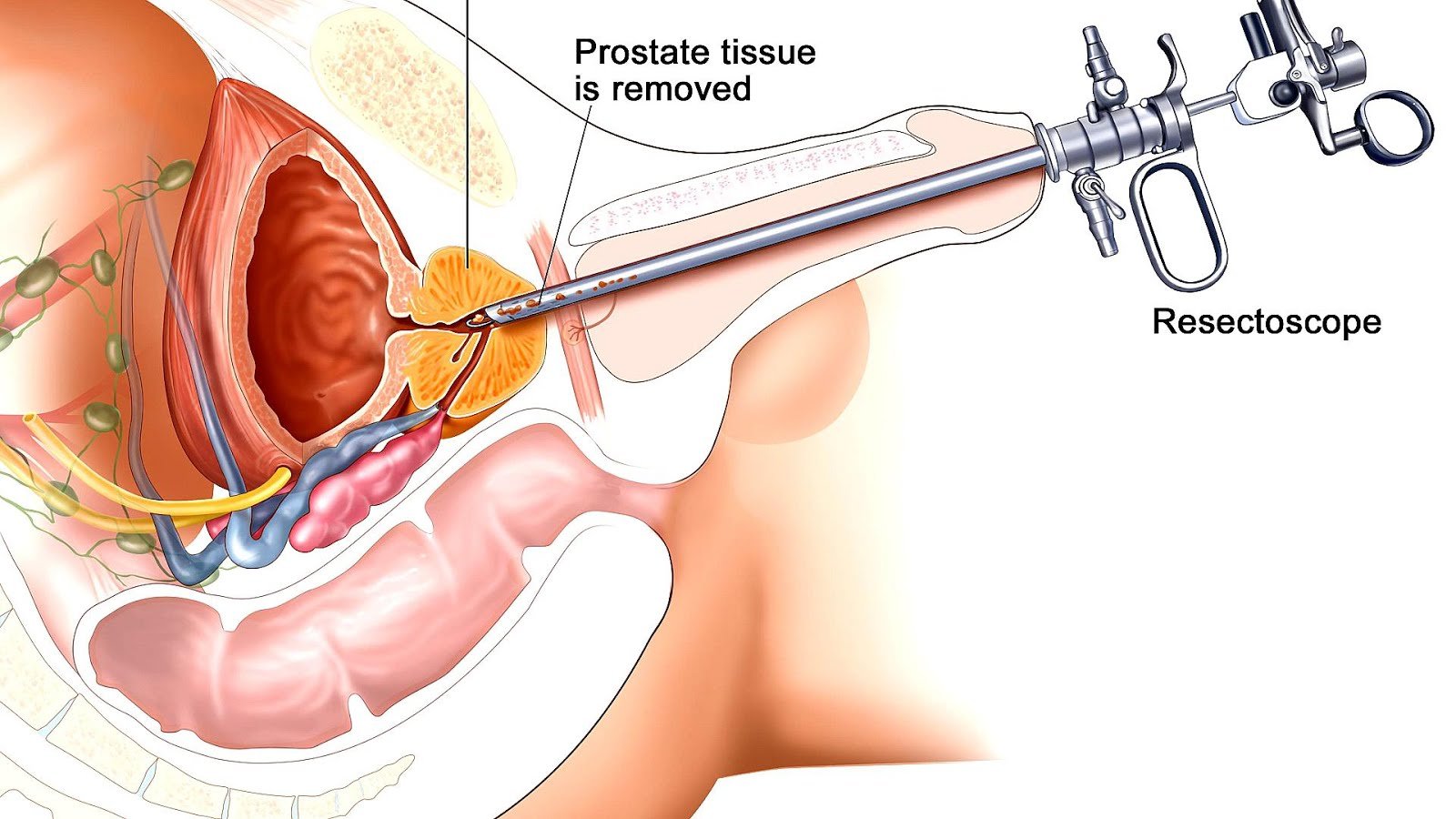 Radiation Side Effects Prostate Cancer
