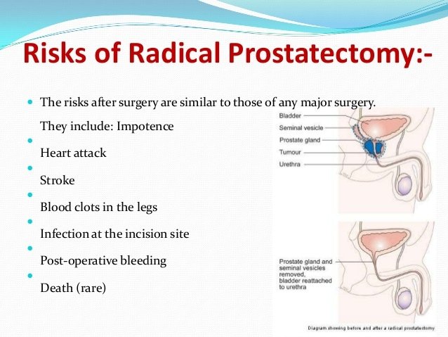 Radical retropubic prostatectomy india