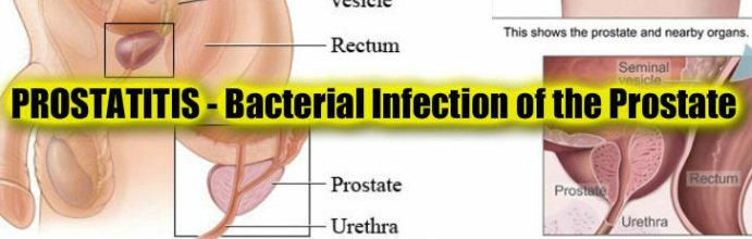 Real Talk: Prostatitis  Bacterial Infection of the ...
