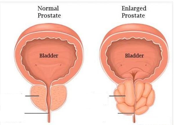 Signs Of Enlarged Prostate And How Avoid It