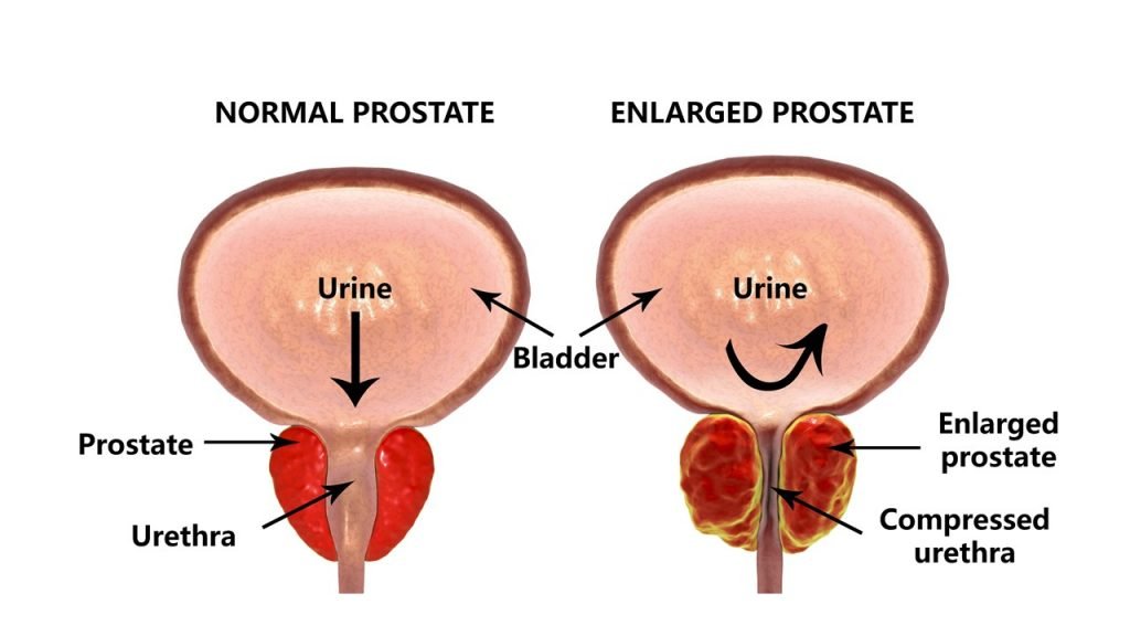 Signs you may be suffering from an enlarged prostate