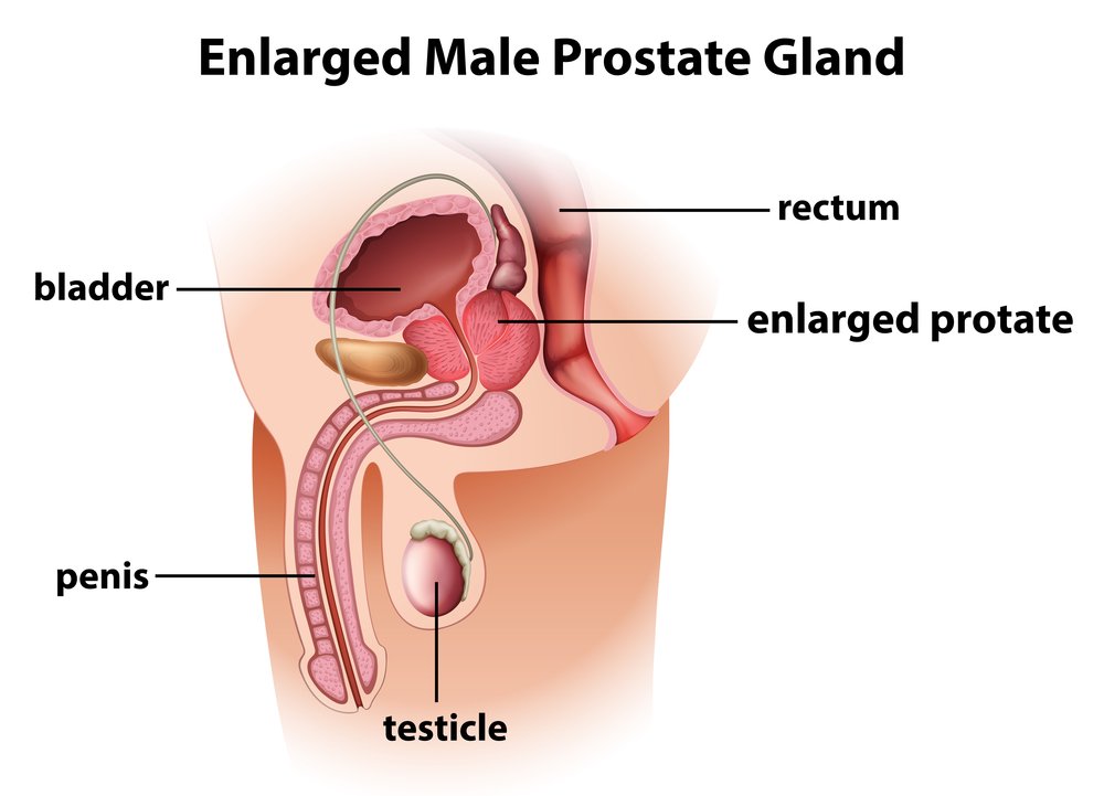 Taking care of your Prostate