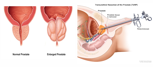 Tested Approach To End Enlarged Prostate And Urinary Problems