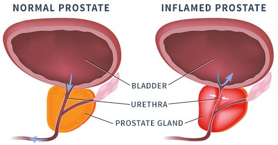 The Effects of Prostatitis (With images)
