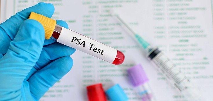 The PSA Prostate Cancer Test: Should You Get Tested?