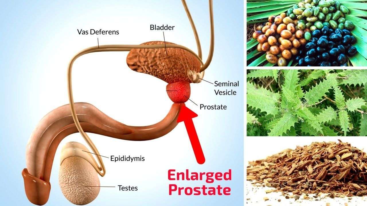 Top 5 Natural Home Remedies For Enlarged Prostate ...