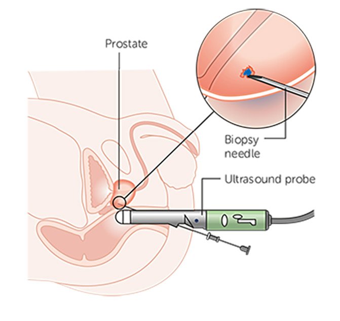 Transrectal Ultrasound Guided Biopsy of Prostate  MKM ...