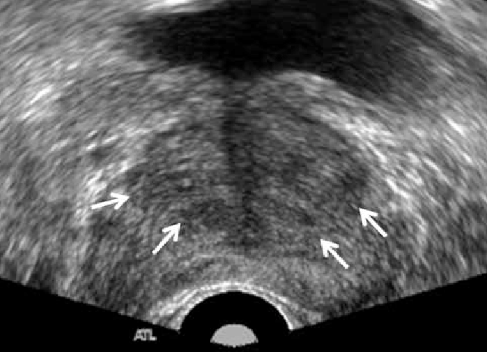 Transrectal ultrasound of benign prostate hyperplasia ...