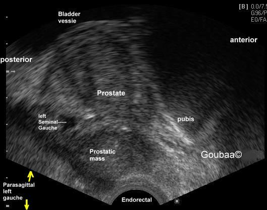 Transrectal ultrasound of the prostate cpt code xin