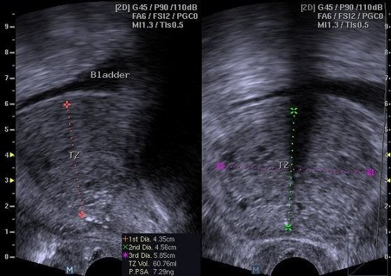 Transrectal ultrasound of the prostate showing measurement ...