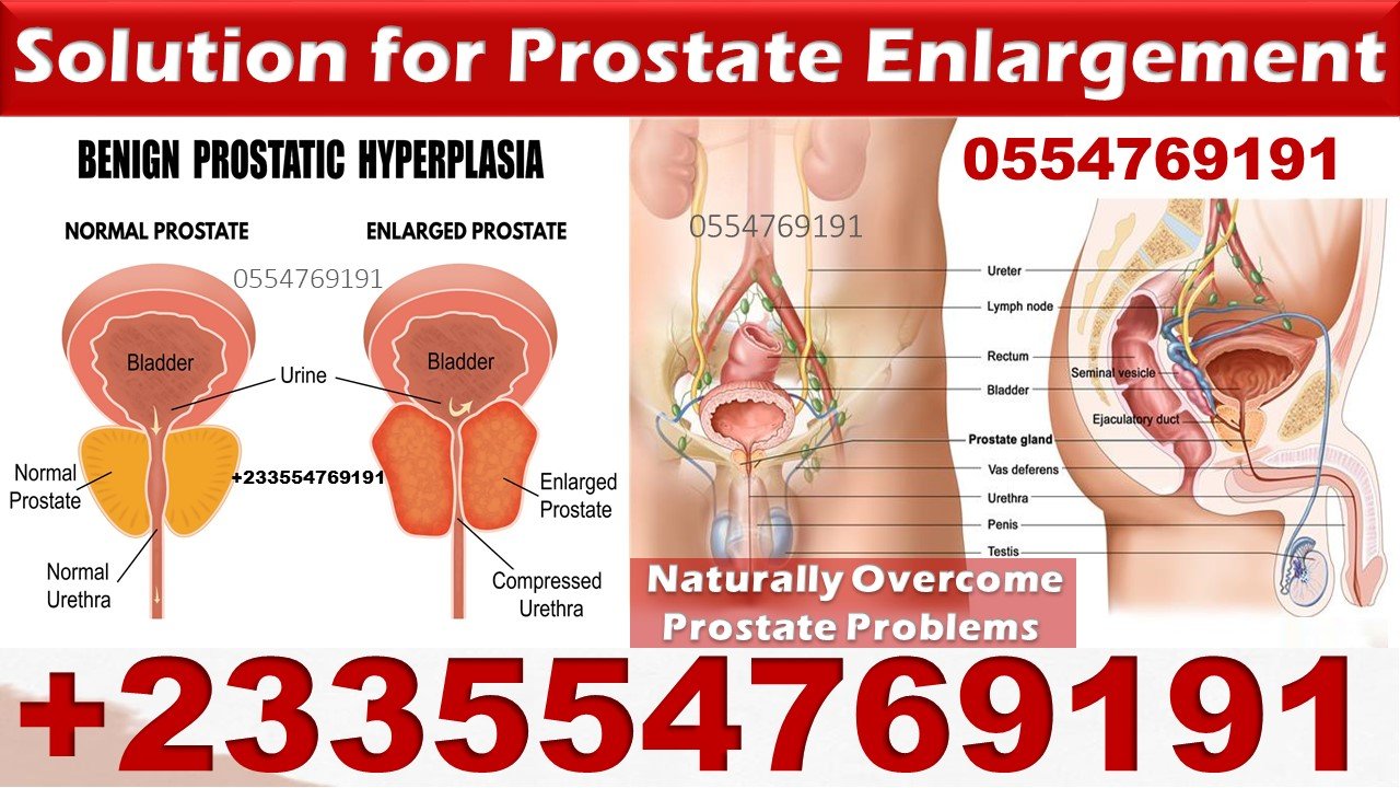 Treatment for Prostate Enlargement In Ghana  Sky Natural ...