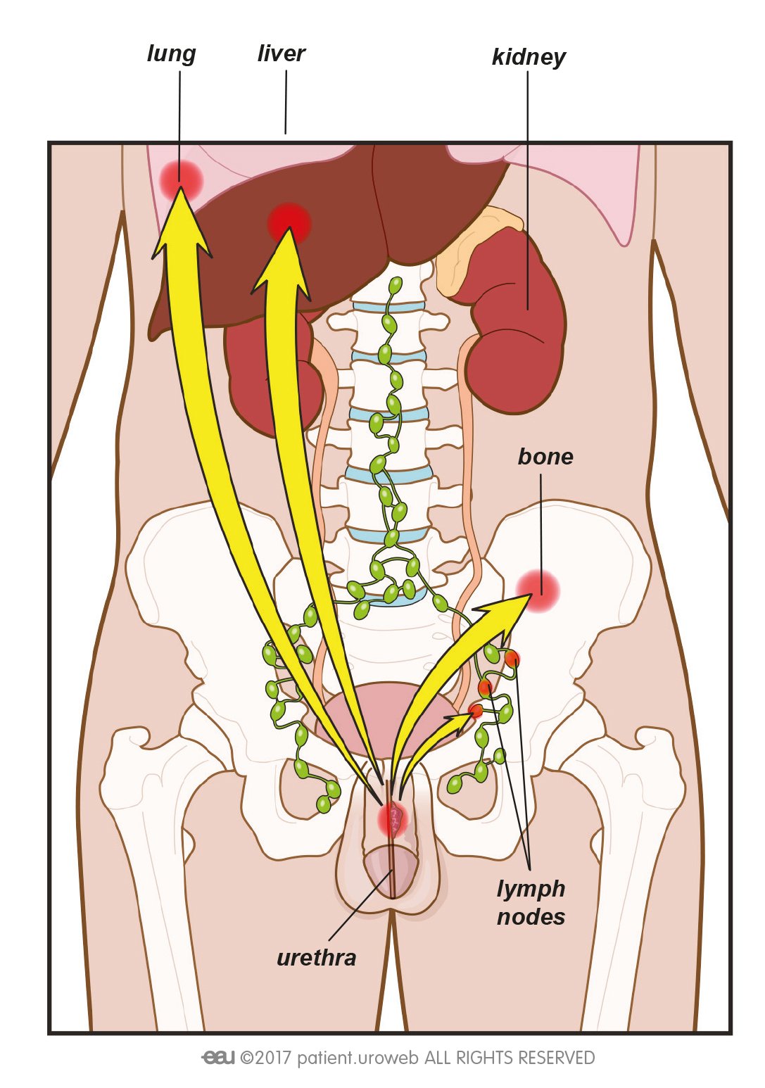 Treatment of primary urethral cancer