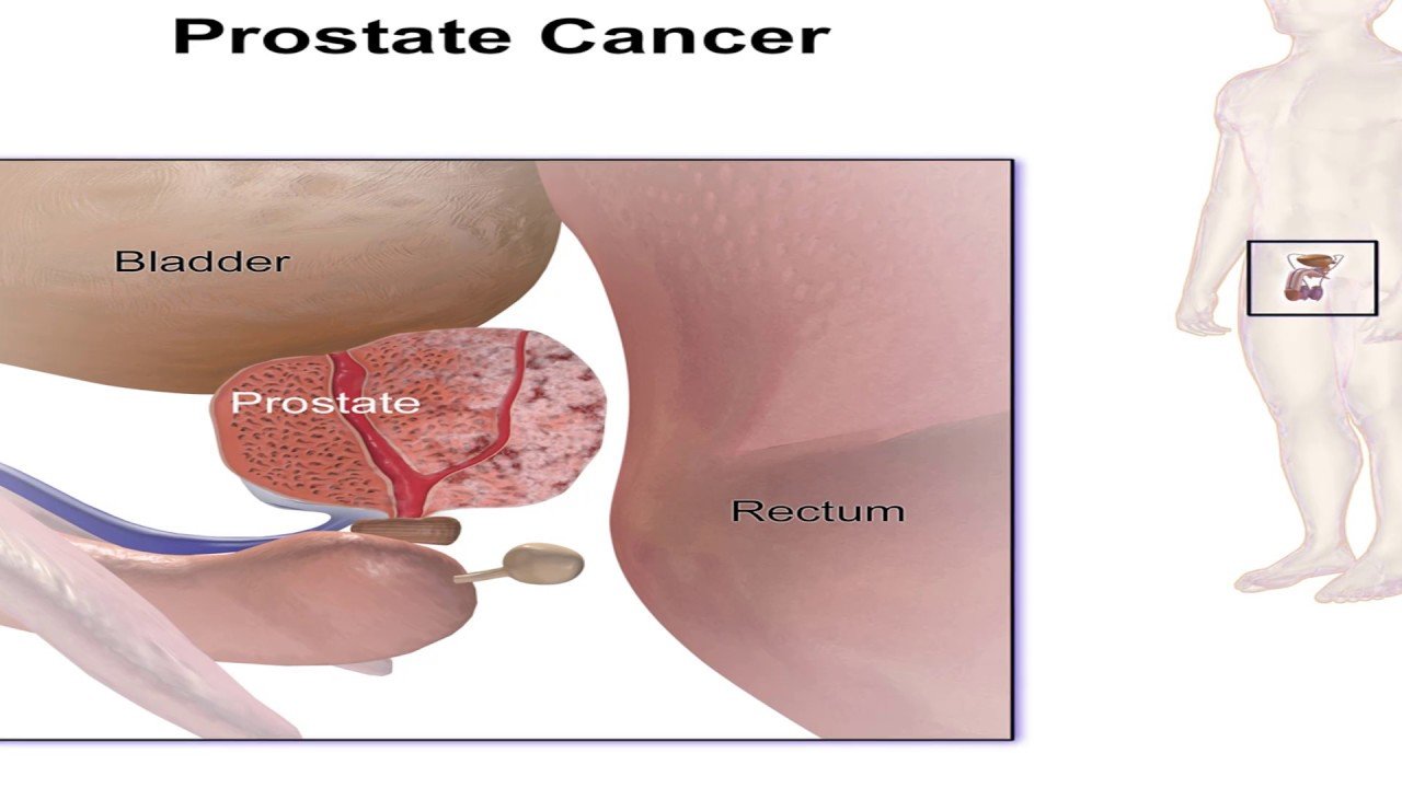 Understanding Advanced Stage 4 Prostate Cancer