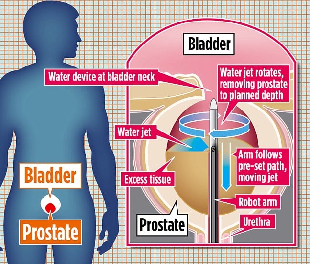 Water jet that washes away prostate problem could cure frequent peeing ...