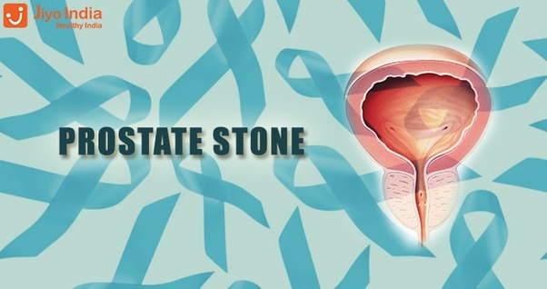 What are symptoms of prostate stones?