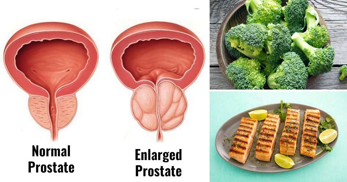 What Are the Best Foods for an Enlarged Prostate