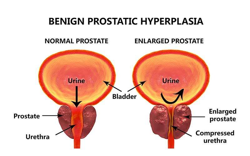 What Are The Symptoms Of Prostate Cancer Spreading / What ...