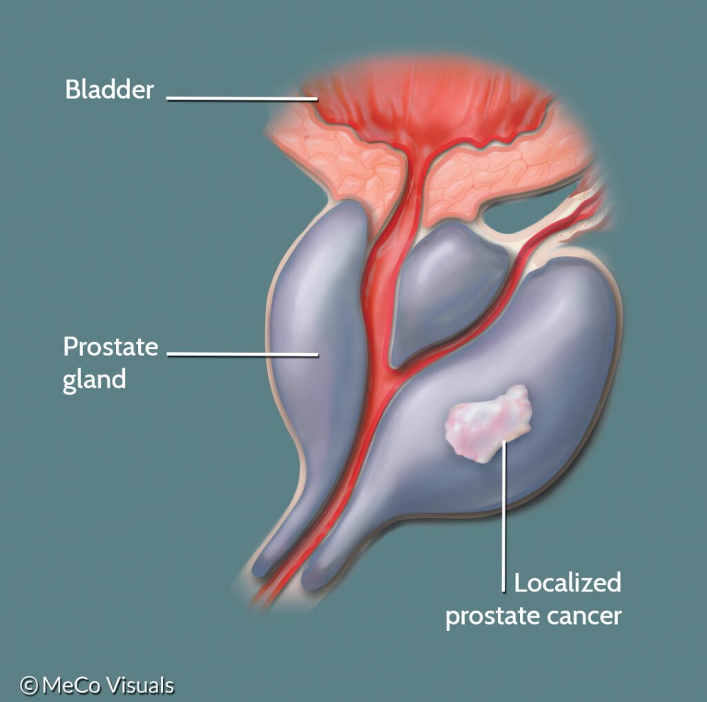 What is Localized or Locally Advanced Prostate Cancer?