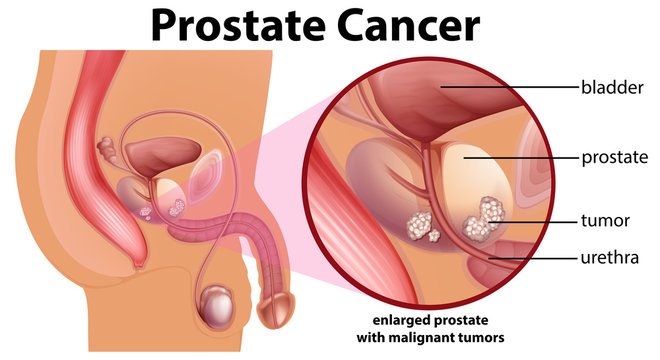 What Is Prostate Cancer