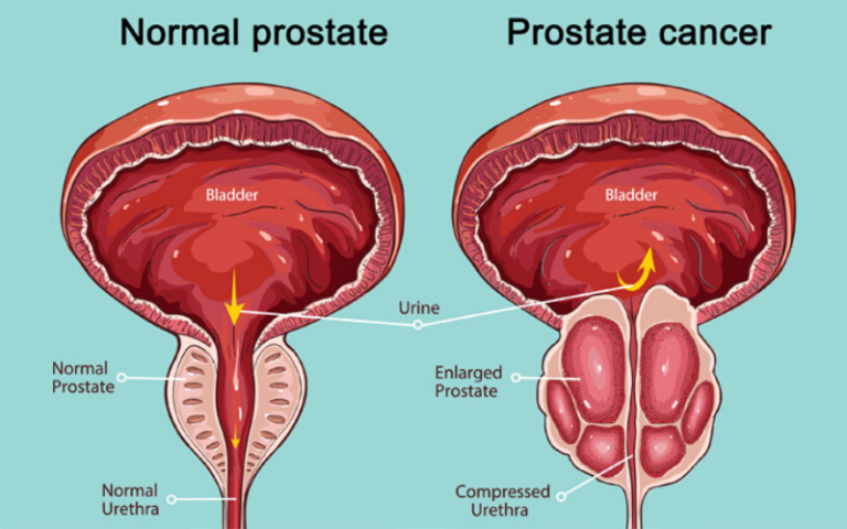 What Is Prostate Health And How To Prevent Prostate Cancer ...