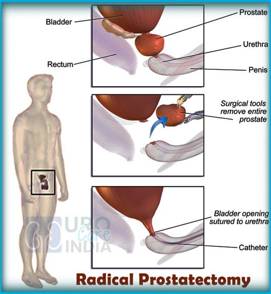 What Is Prostate Surgery