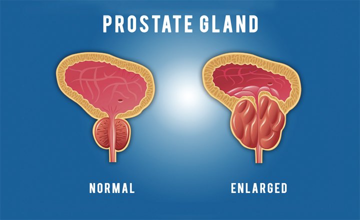 What You Should Know About Your Prostate (Men Only ...